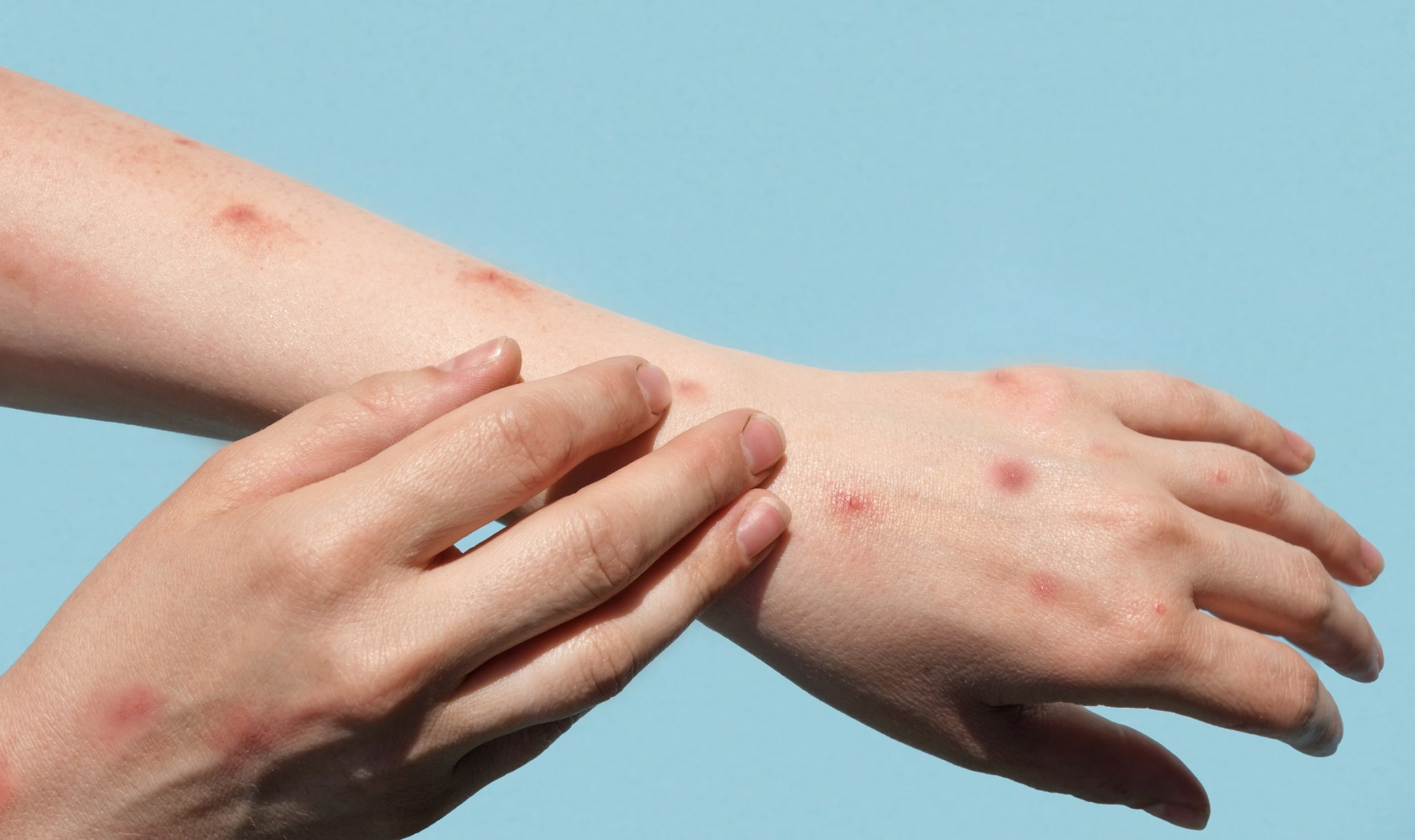 Symptoms of Monkeypox